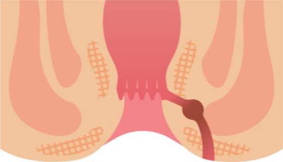 Fistula specialist in Hadapsar