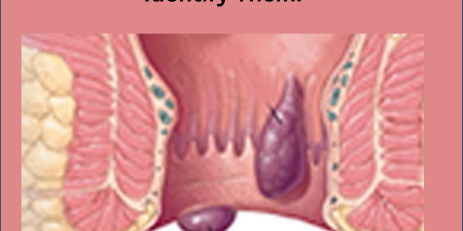 Best Piles Treatment In Hadapsar.