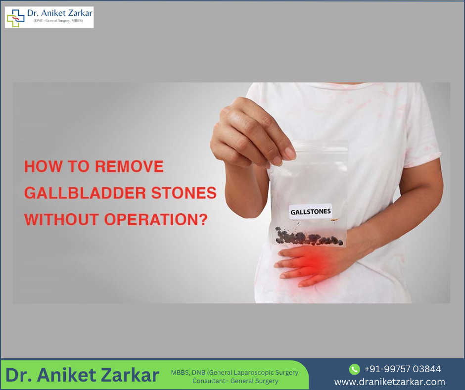 How To Remove Gallbladder Stones Without Operation