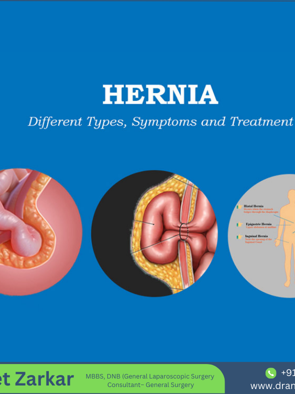Hernia treatment in hadapsar