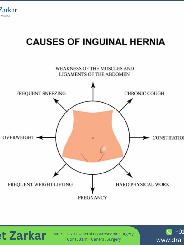 Hernia treatment in hadapsar