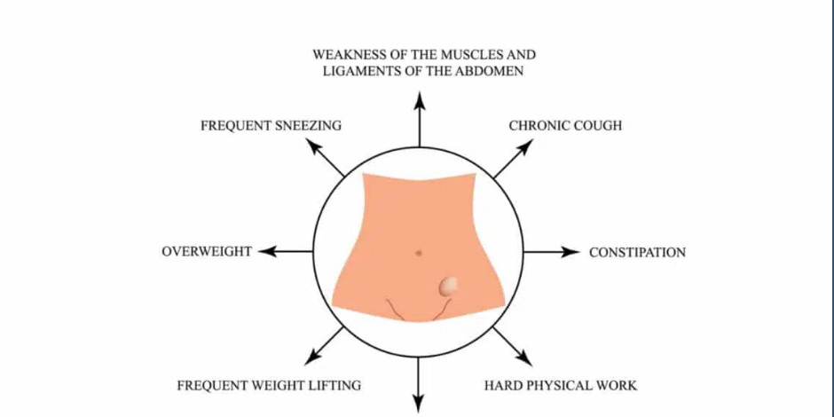 Types of Hernia Hernia treatment in hadapsar