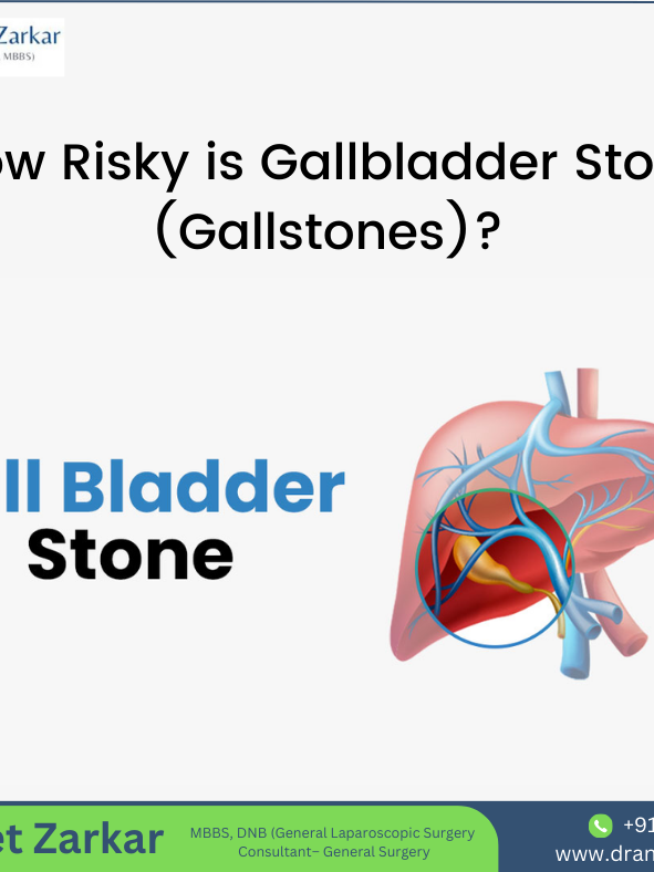 How Risky is Gallbladder Stone (Gallstones)? Gallbladder Stone