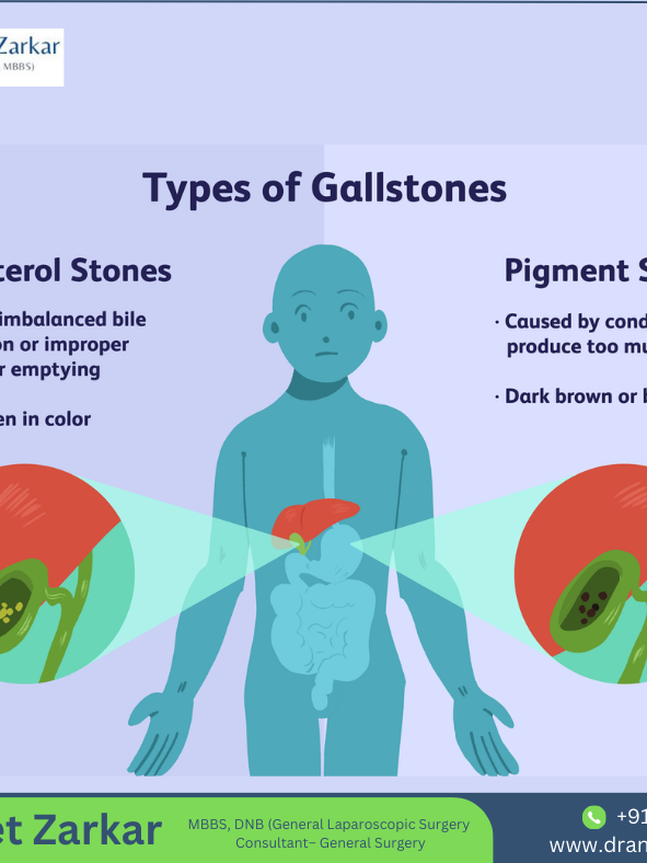 What Is Gall Stone And How Are Stones Formed In Gallbladder? Gallbladder