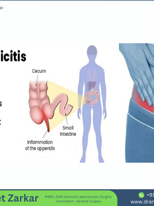 KNOWING THE RED FLAGS FOR APPENDICITIS APPENDICITIS
